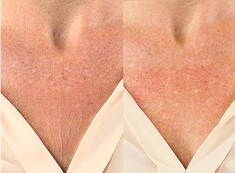 DermaSil Dekolleté-Pad